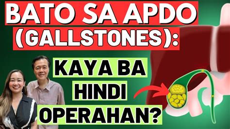 magkano ang operasyon sa bato sa apdo|BATO SA APDO: Gallbladder Flush, Gamot or .